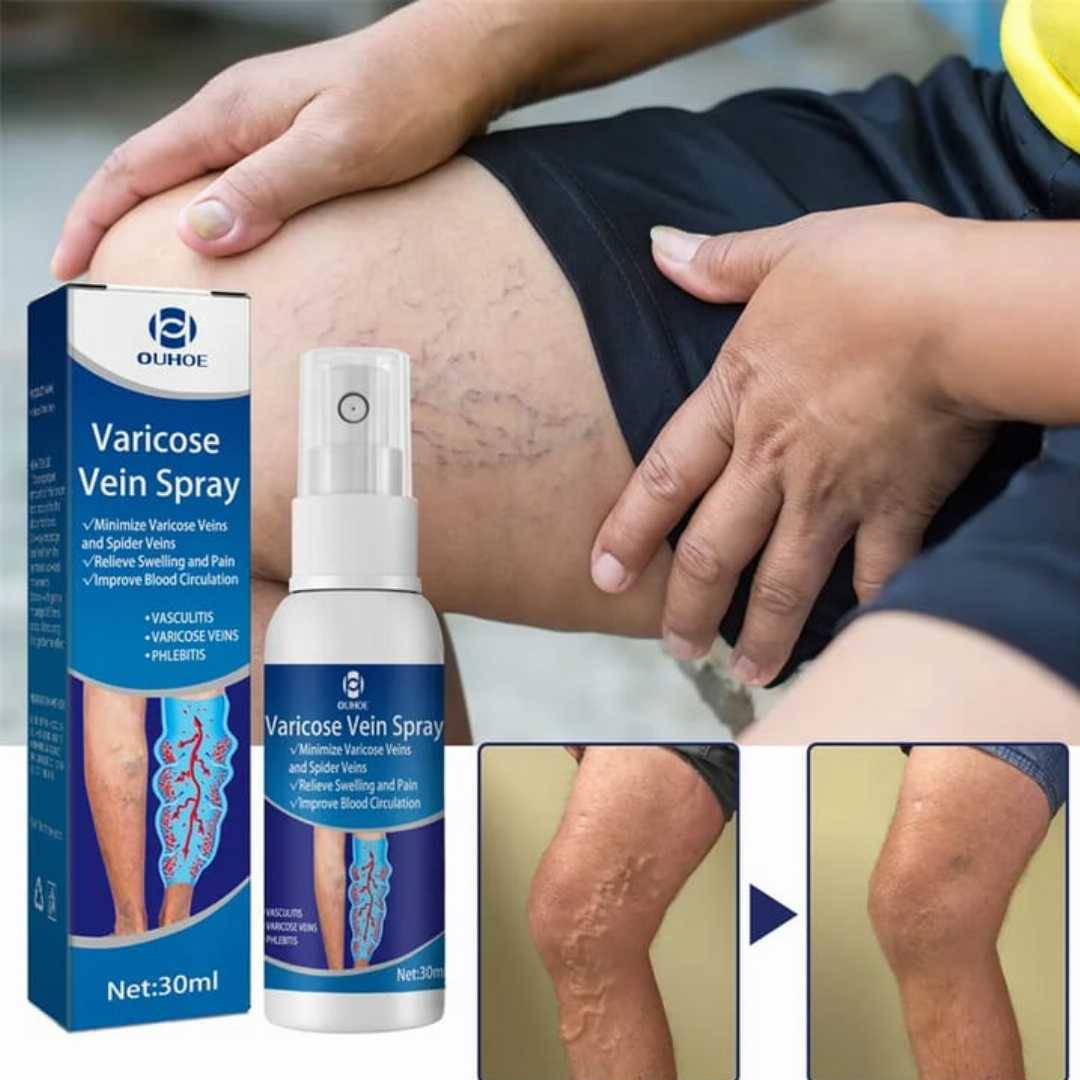 Varicose,Veins,Spray